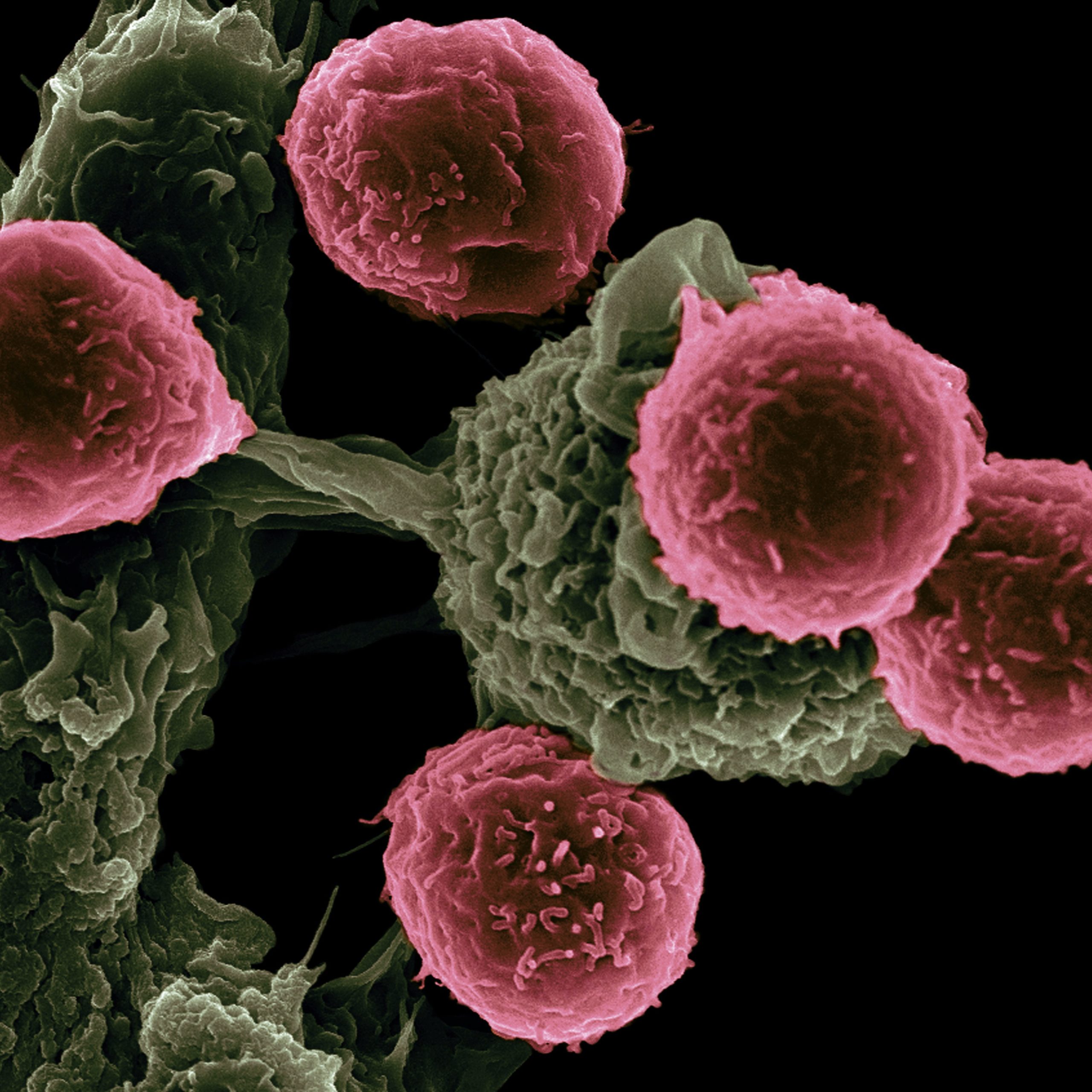 Karzinome mit Stammzellen behandeln